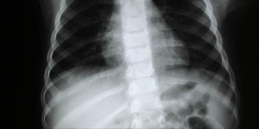 Omurga eğriliği tanısında yeni yöntem