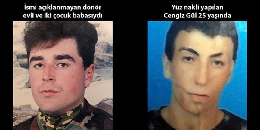 Türkiye'deki 2. yüz nakli yapıldı