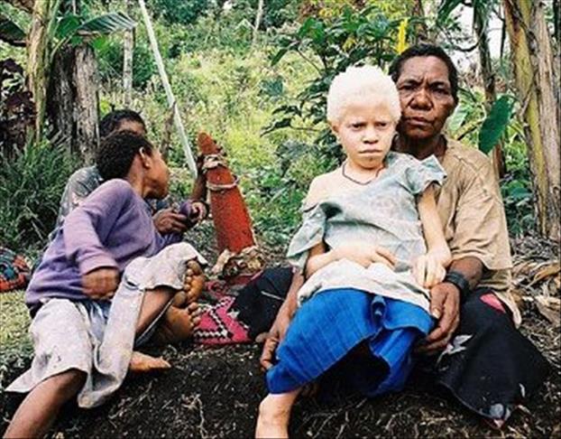 Turkey to help children with albinism in Tanzania