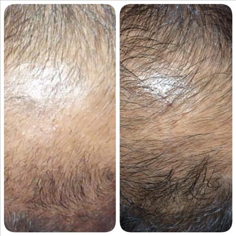 Hair transplants becoming major Turkish industry