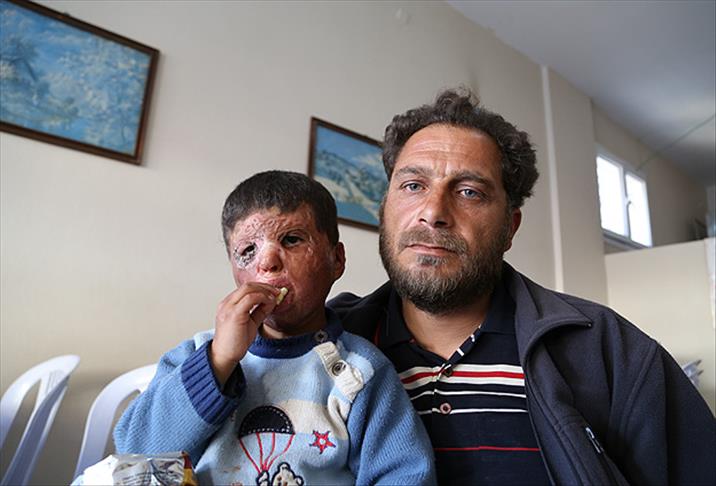 Küçük Mustafa savaşın izini yüzünden silmek istiyor