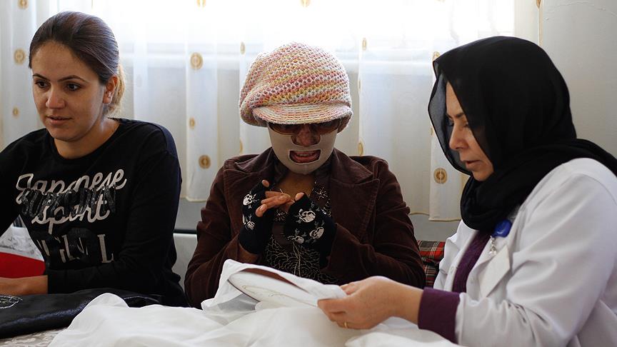 Yüzü yanan kadın ailesinin desteğiyle hayata tutundu