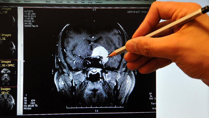 Brain implant restores movement for US quadriplegic
