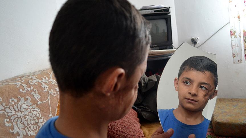 Yaranın izini silecek doku için kilo almayı bekliyor