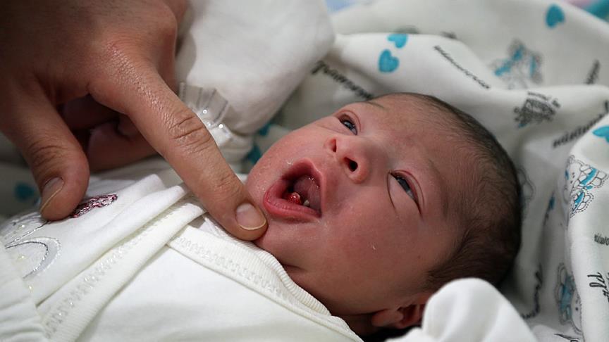 Turkish baby born with two lower teeth