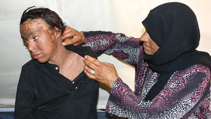 Suriyeli genç balık pulu hastalığıyla mücadele ediyor