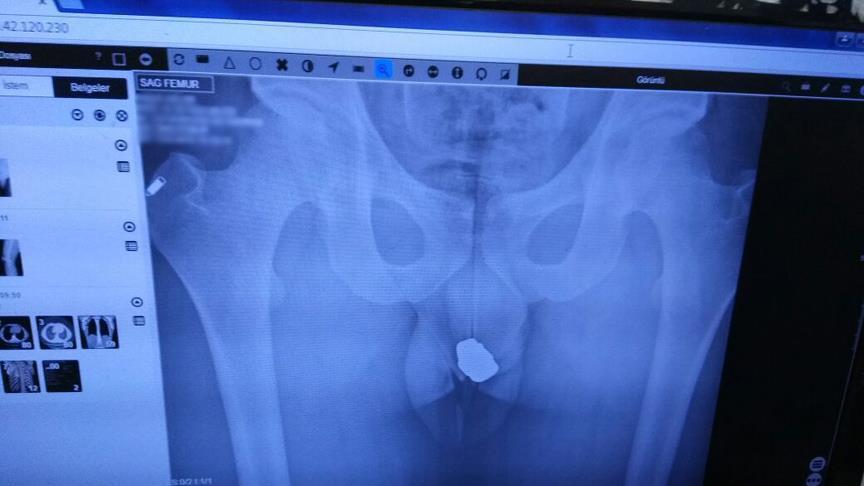 Turkey: X-ray reveals jewels hidden inside thief's body
