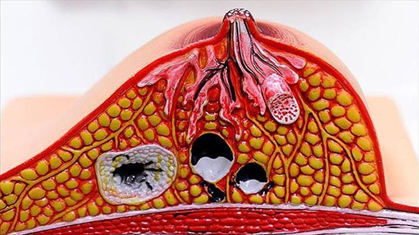 800 ألف امرأة يموتون سنويًا حول العالم بسبب السرطان (دراسة) 