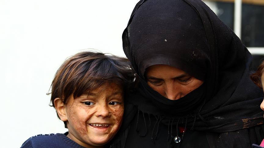 Minik Suriyeli savaşın izlerini yüzünde taşıyor