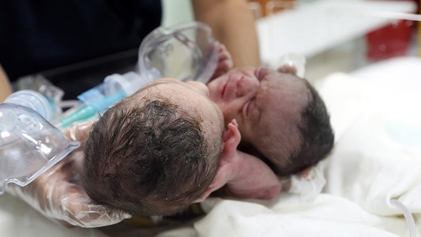 نوزادان دوقلوی سیامی سوری در ترکیه درمان می شوند