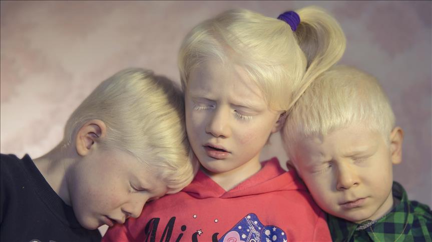 Problemet e albinëve, më shumë "pengohen nga shikimet kureshtare në rrugë"