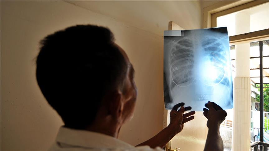 Aumentan los casos de tuberculosis en Venezuela
