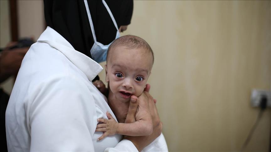 Malnutrition kills 2 babies in Syria’s Eastern Ghouta