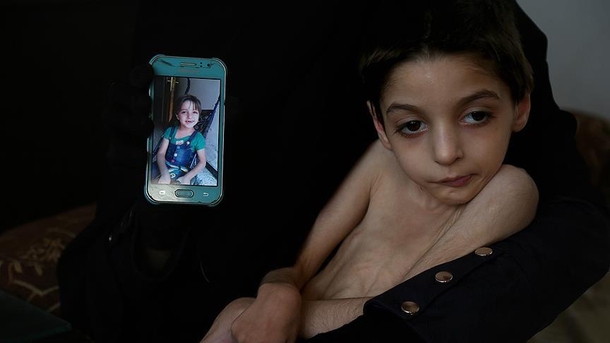 Suriyeli çocuk ölüm döşeğinde açlık çekiyor