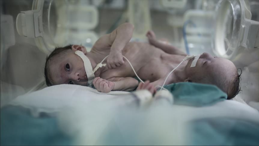 "فرح" و"حنين"..أول توأم سيامي من غزة يعيش لأكثر من شهر 