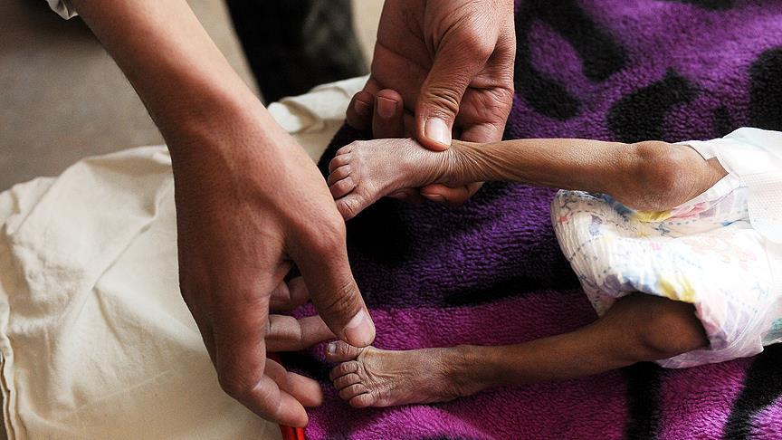Yemen'deki difteri salgınında ölenlerin sayısı 34'e yükseldi