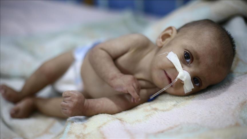 Baby succumbs to malnutrition in Syria's Eastern Ghouta