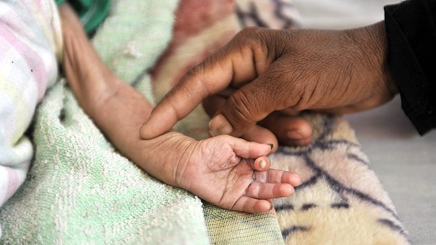 En Indonesia han muerto 61 niños por sarampión y desnutrición