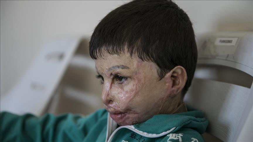 Turquie : Un petit syrien défiguré par les bombes du régime 