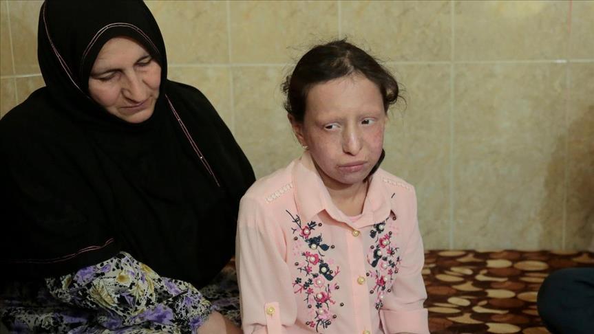 (سیندرۆمی رۆسمۆند تۆمسۆن) نەخۆشییەکی دەگمەن