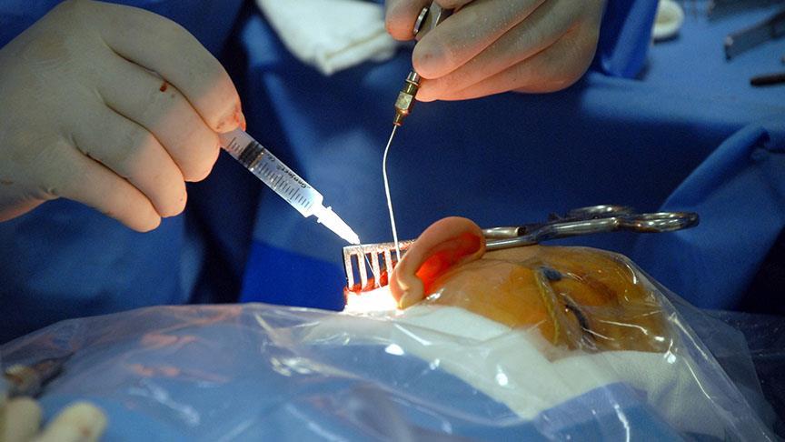 Isitme Tedavisinde Biyonik Kulak Teknolojisi Hizla Gelisiyor