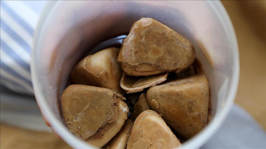 Turska: Ljekari iz mokraćnog mjehura odstranili 840 grama kamenčića