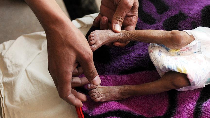 'Yemen'de yaklaşık 85 bin çocuk yetersiz beslenmeden ölmüş olabilir'