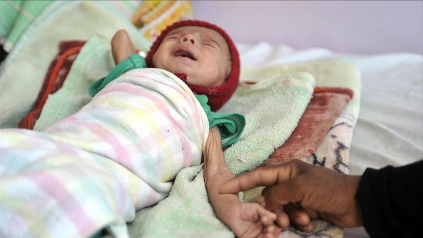 Околу 85.000 деца под 5-годишна возраст во Јемен починаа од глад