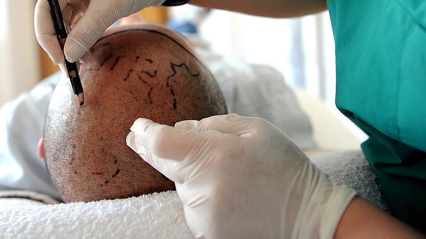 Turquía es el principal destino para trasplantes de cabello en Europa