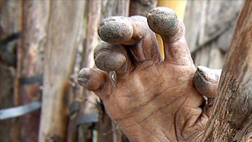 Poverty Disability And Stigma Depress Ethiopian Lepers