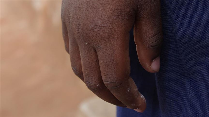 Nijeryalı çocuğu satılmaktan yüzündeki kabile izleri kurtardı