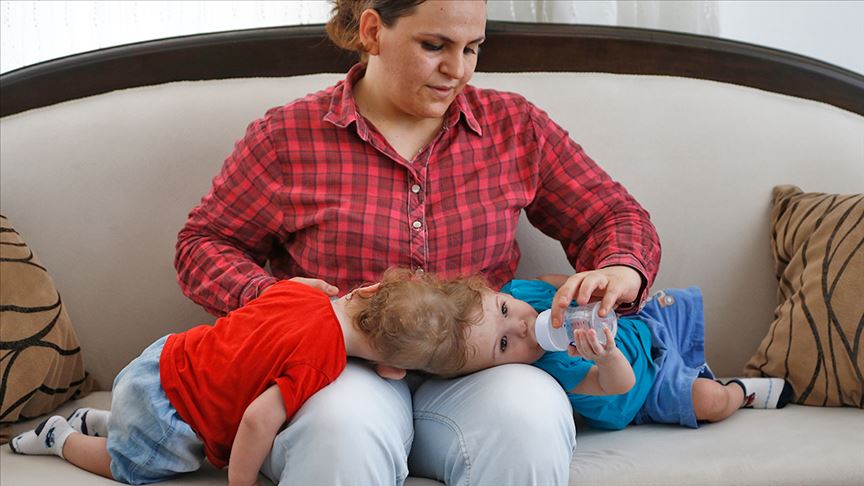 Kafadan yapışık siyam ikizleri bir yaşında