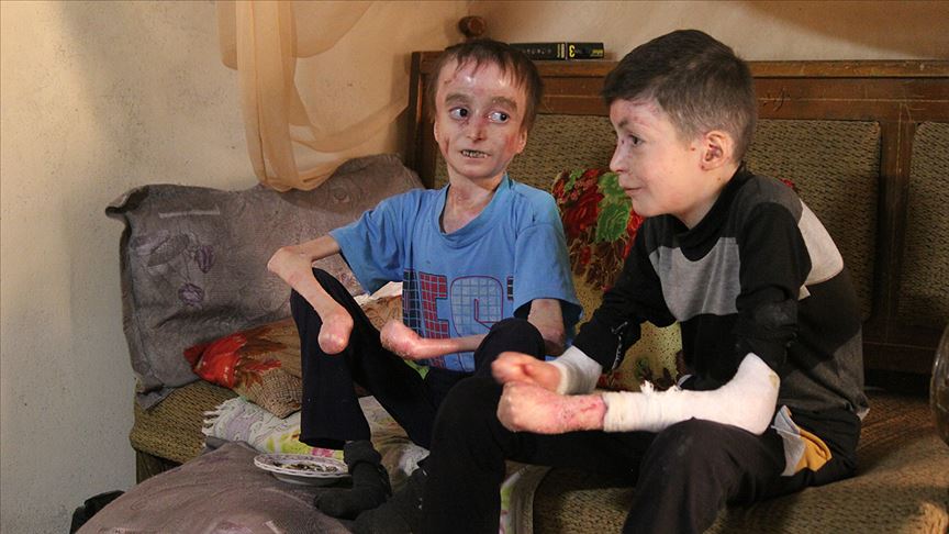 İdlib'in 'kelebek hastası' kuzenleri tedavi için yardım bekliyor 