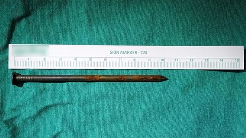 Doctors remove 10-cm nail from patient’s lungs