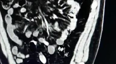 Turkey:Police arrest man carrying drug pills in stomach