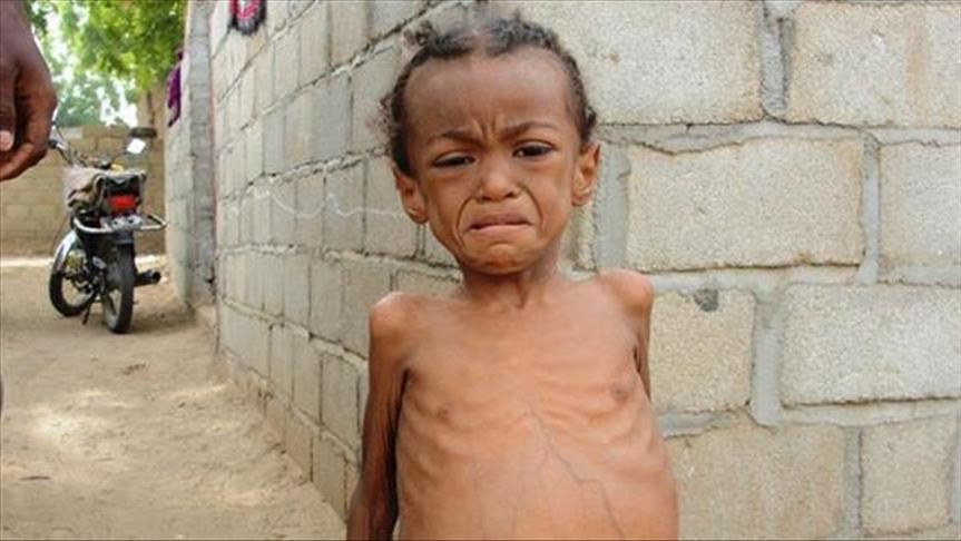 الأمم المتحدة: اليمن الأفقر في العالم حال استمرت الحرب حتى 2022 ترتفع إلى 75 بالمئة 