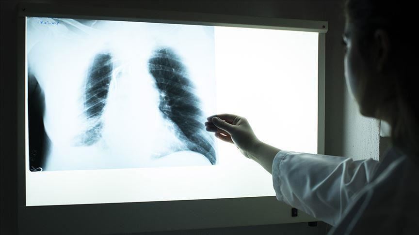 Smoking raises risk of contracting pneumonia