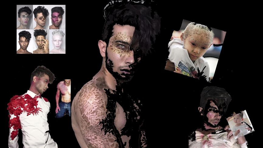 Gaza painter uses art to depict rare medical disorders