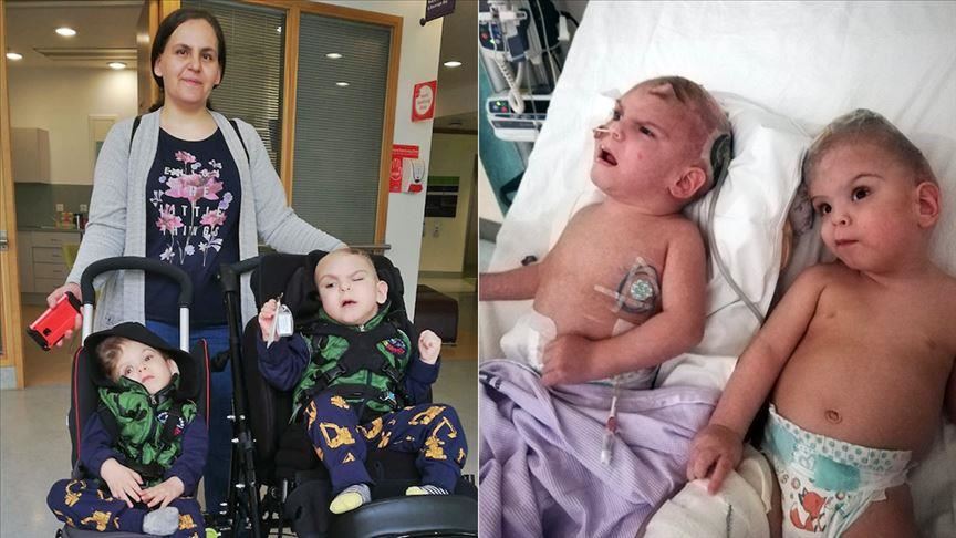 Turkish Conjoined Twins To Return After Successful Op In Uk Turkish Conjoined Twins To Return After Successful Op In Uk