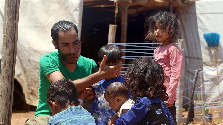 Esed bombardımanında yüzü yanan baba çocuklarına sarılabilmek için tedavi olmak istiyor