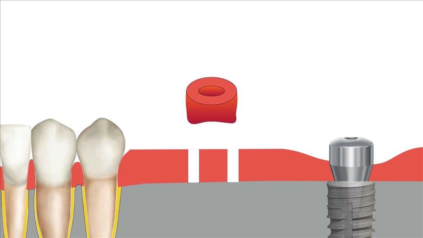 Método desarrollado por un turco para trasplantar la encía en implantes dentales es usado en 50 países