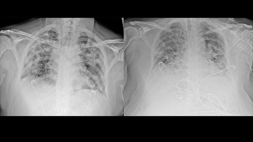 Снимките ја покажуваат штетата која ја предизвикува Ковид-19 на белите дробови