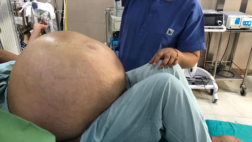 Doctors remove world’s largest tumor in India