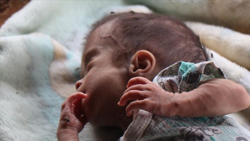 نور ئەو کۆرپەیەی کە گرێیەک لە بڕبڕەی پشتیدا هەیە