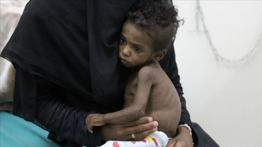 الأمم المتحدة: ارتفاع حالات سوء التغذية بين أطفال جنوب اليمن