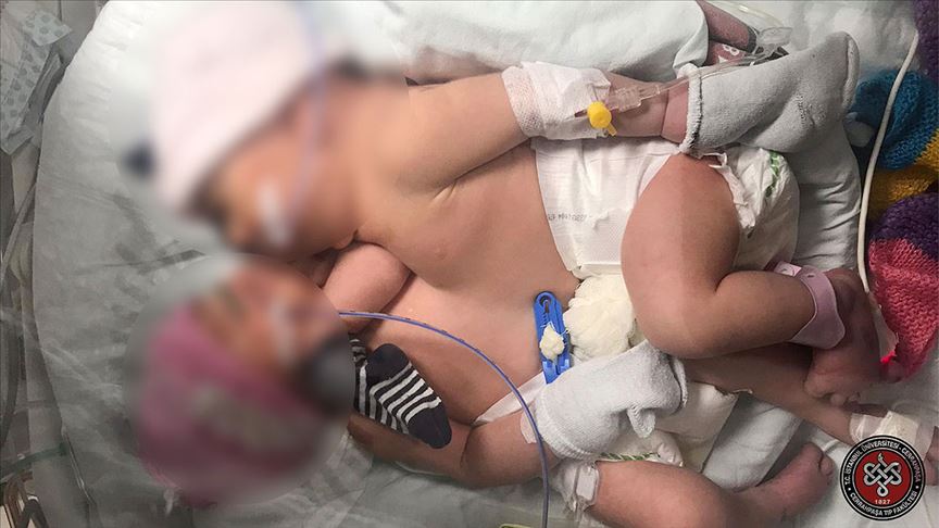 Karın ve göğüsten yapışık ikizler 11 saatlik operasyonla ayrıldı