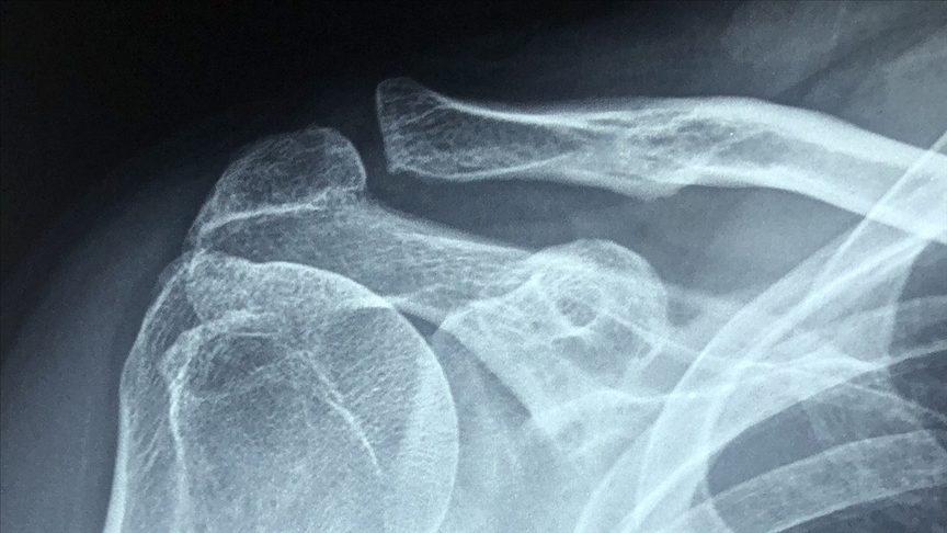Tekrarlayan omuz çıkıklarında artroskopik tedavi ile iyileşme mümkün