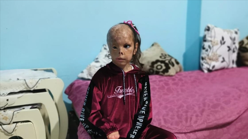 Bebekken yüzü yanan Dilara'nın ailesi yardım eli uzatılmasının sevincini yaşıyor