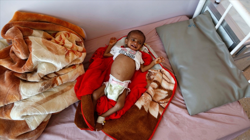Yemen'de akut yetersiz beslenme sorunu çocukların hayatını karartıyor