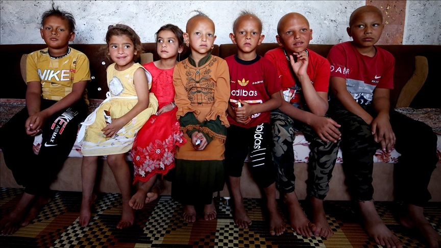بە هۆی نەخۆشییەکی دەگمەنەوە ٤٢ کەس لە دانیشتوانی گوندێکی کەرکووک کەچەڵ بوون